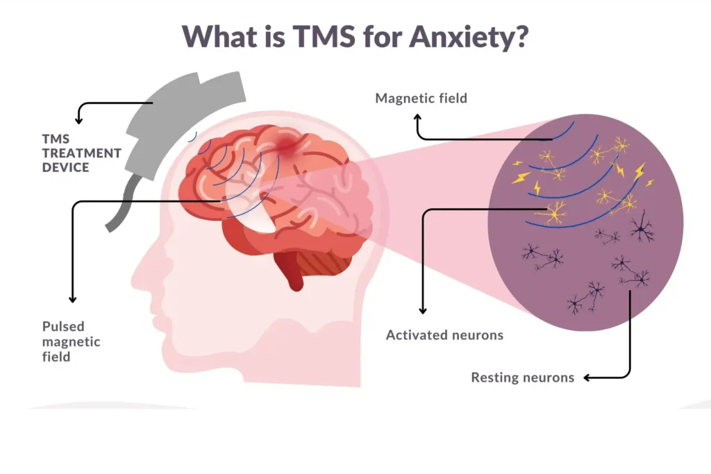 TMS for anxiety treatment showing non-invasive brain stimulation therapy used to reduce anxiety symptoms